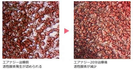 エアナジー治療前後